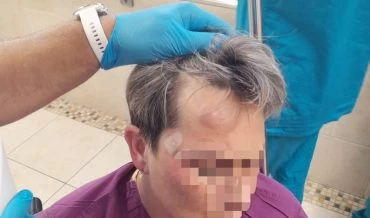 סימני האלימות על מצחה של הסייעת (צילום: דוברות רמב"ם)